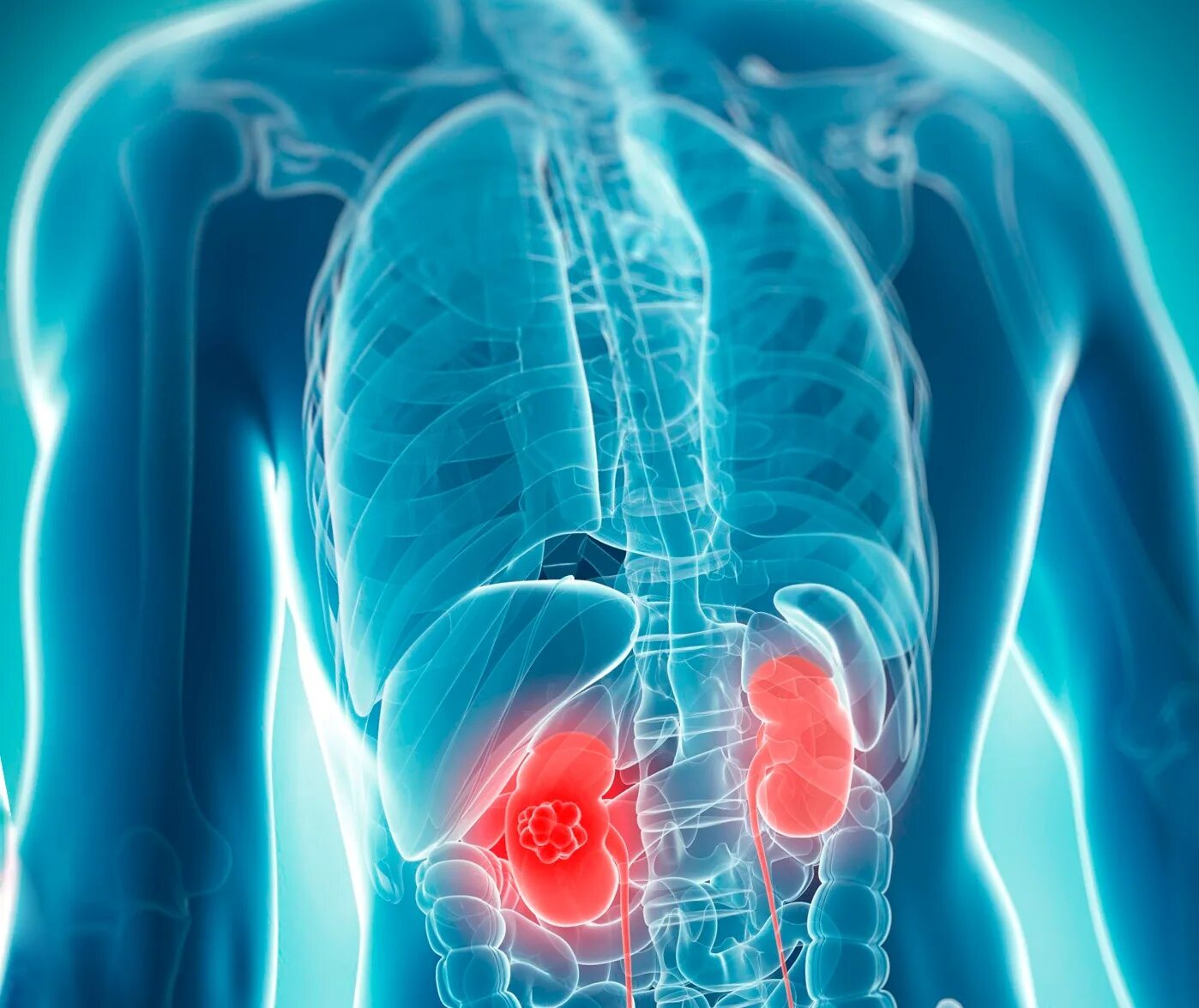 гидрокаликоз почек что это такое. прогрев почек. болит почка при движении. почки рисунок. прогрев почек.