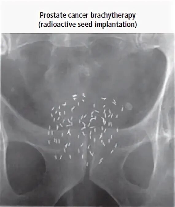 Контактная лучевая терапия брахитерапия это. Брахитерапия (внутритканевая лучевая терапия). Брахитерапия предстательной железы. Брахитерапия простаты на кт. Брахитерапия простаты цена