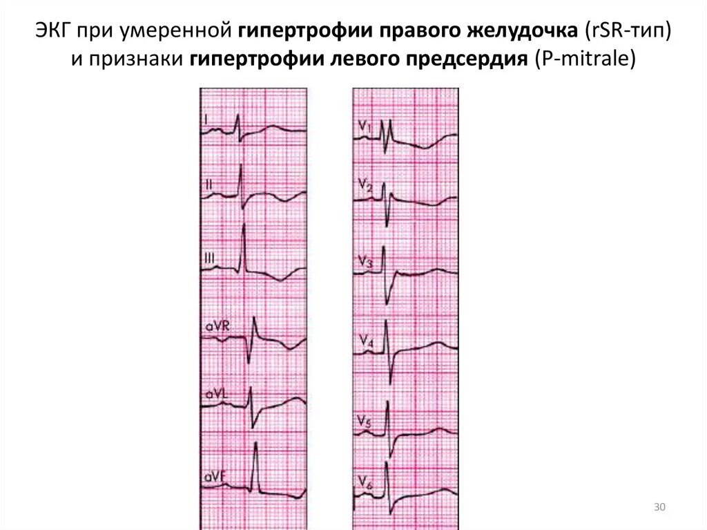 Гипертрофия правого желудочка типа RSR. RSR на ЭКГ гипертрофия правого желудочка. Гипертрофия правого желудочка на ЭКГ RSR Тип. Гипертрофия левого желудочка на ЭКГ. Гипертрофия левого предсердия левого желудочка