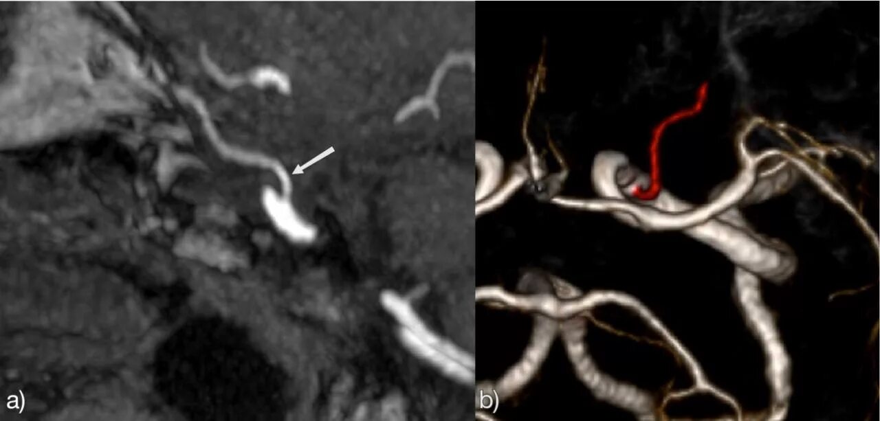 Гипоплазия позвоночной артерии. Гипоплазия позвоночной артерии мрт. Гипоплазия левой позвоночной артерии. Гипоплазия правой позвоночной артерии мрт. Гипоплазия правого поперечного синуса
