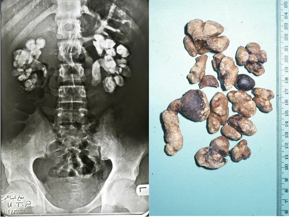Камни в почках видел. Мочекаменная болезнь коралловидные камни. Мочекаменная болезнь (нефролитиаз). Коралловидный нефролитиаз. Коралловидный камень в почке рентген.