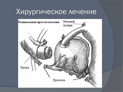 Радикальная простатэктомия