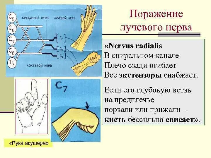 Поражение нервов руки. Поражение лучевого нерва. Синдром поражения лучевого нерва. Аксональное поражение лучевого нерва. Поражение лучевого нерва в СПИРАЛЬНОМ канале.