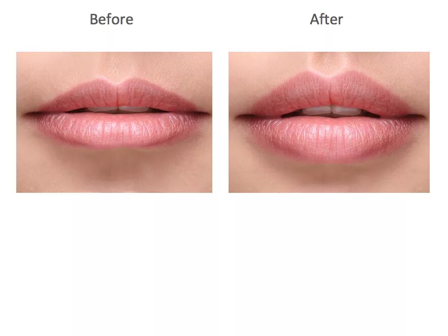 Губ максимального уровня. Ювидерм липс для губ. juvederm ultra 3 губы до после. ювидерм волбелла. увеличение губ ювидерм.