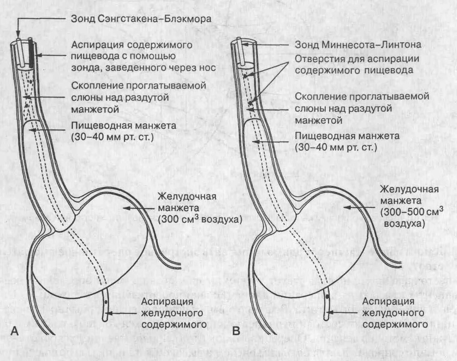 Абляция пищевода. Зонд Блэкмора объем манжет. Желудочный зонд Блэкмора. Зонд Блэкмора для остановки кровотечения из вен пищевода. При желудочном кровотечении зонд Блэкмора.