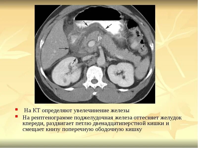 Парапанкреатическая клетчатка что это значит. Хронический панкреатит на кт. парапанкреатическая клетчатка на кт. кт поджелудочной железы. поджелудочная железа на рентгенограмме.