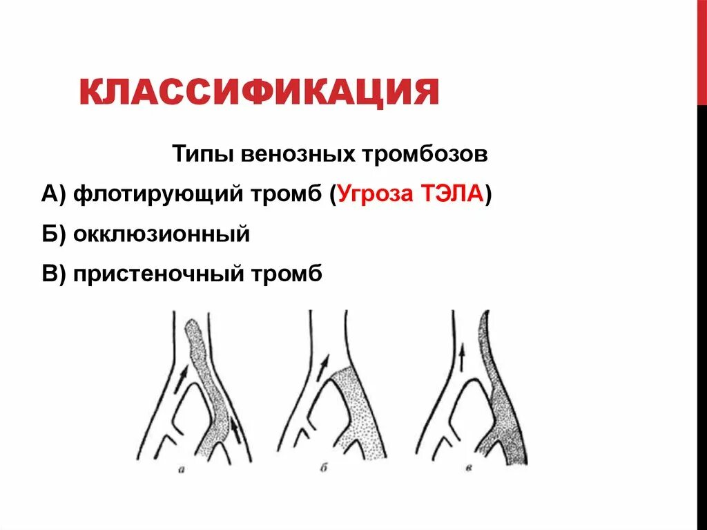 Тромб пристеночный симптомы. Классификация венозных тромбозов. Классификация тромбоза