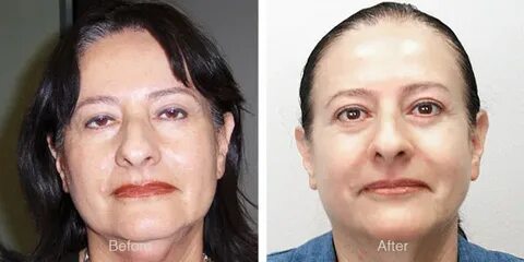 Как действуют липолитики на лице