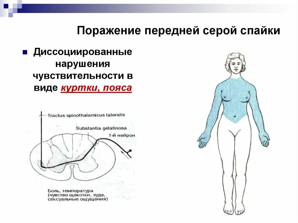 Синдром поражения серой спайки. Синдромы нарушения чувствительности при поражении спинного мозга. Нарушение чувствительности в виде куртки. Расстройство чувствительности по типу куртки.