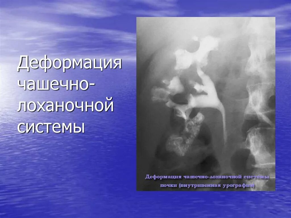 Чашечно лоханочная система на УЗИ. Деформация чашечно-лоханочной системы. Чашечно-лоханочная система почки.