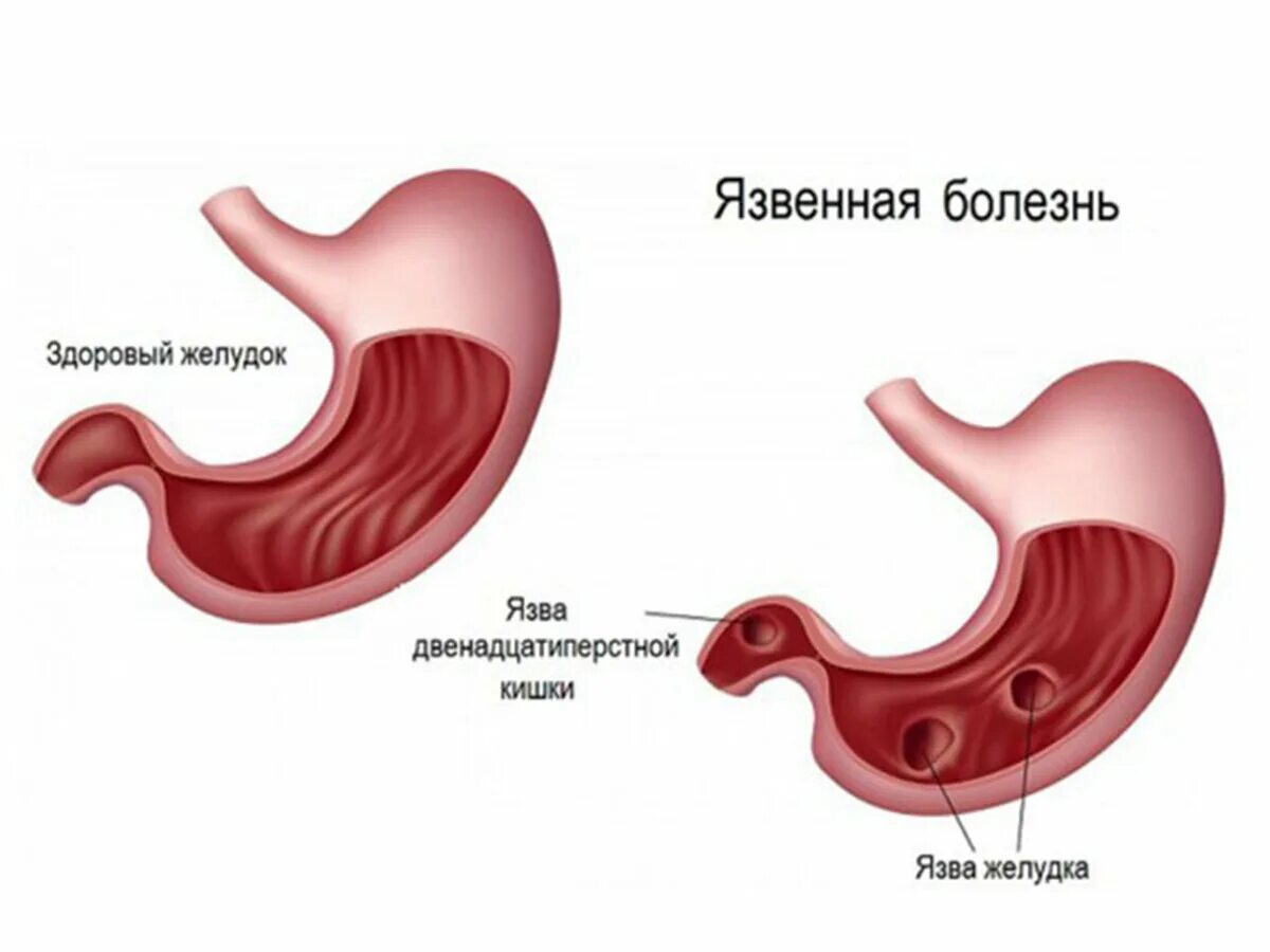 Бактерия хеликобактер пилори, что это такое и как лечить ПульсПлюс Дзен