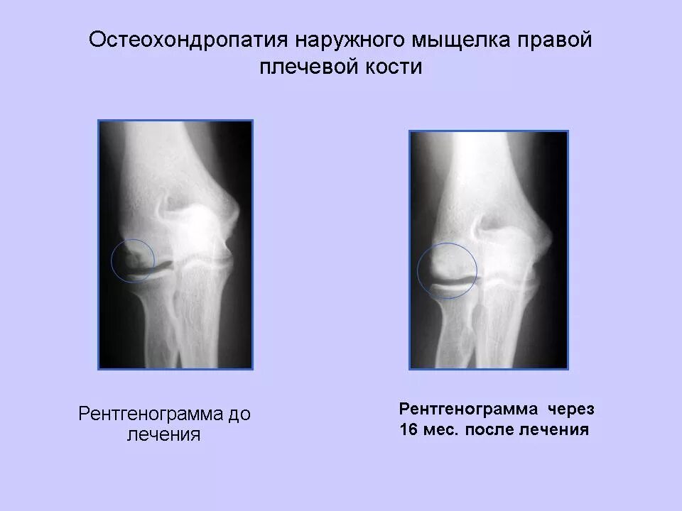 Асептический некроз мыщелков. Остеохондропатия головки мыщелка плечевой кости. Кенига болезнь коленного сустава на рентгене. Болезнь Кенига локтевого сустава. Остеохондропатия большеберцовой кости кости коленного сустава.