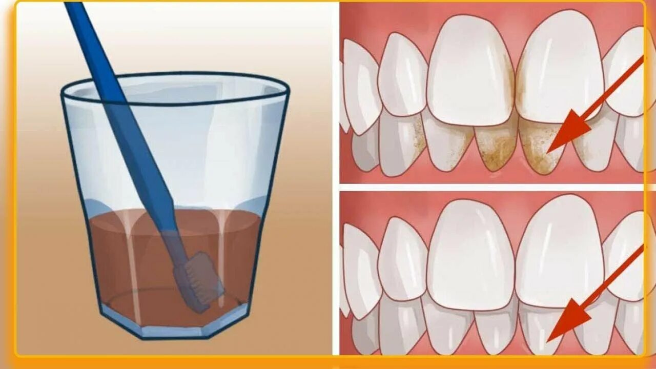 После чистки зубов можно ли пить чай. Коричневый зубной камень.