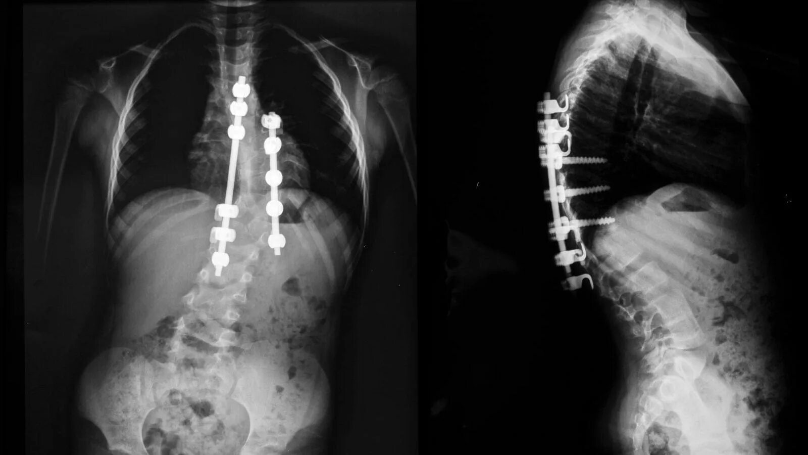 Сколиоз 2 степени рентген. Сколиоз операция рентген. Сколиоз 1 степени поясничного отдела рентген. Левосторонний сколиоз рентген. Конструкция позвоночника операция