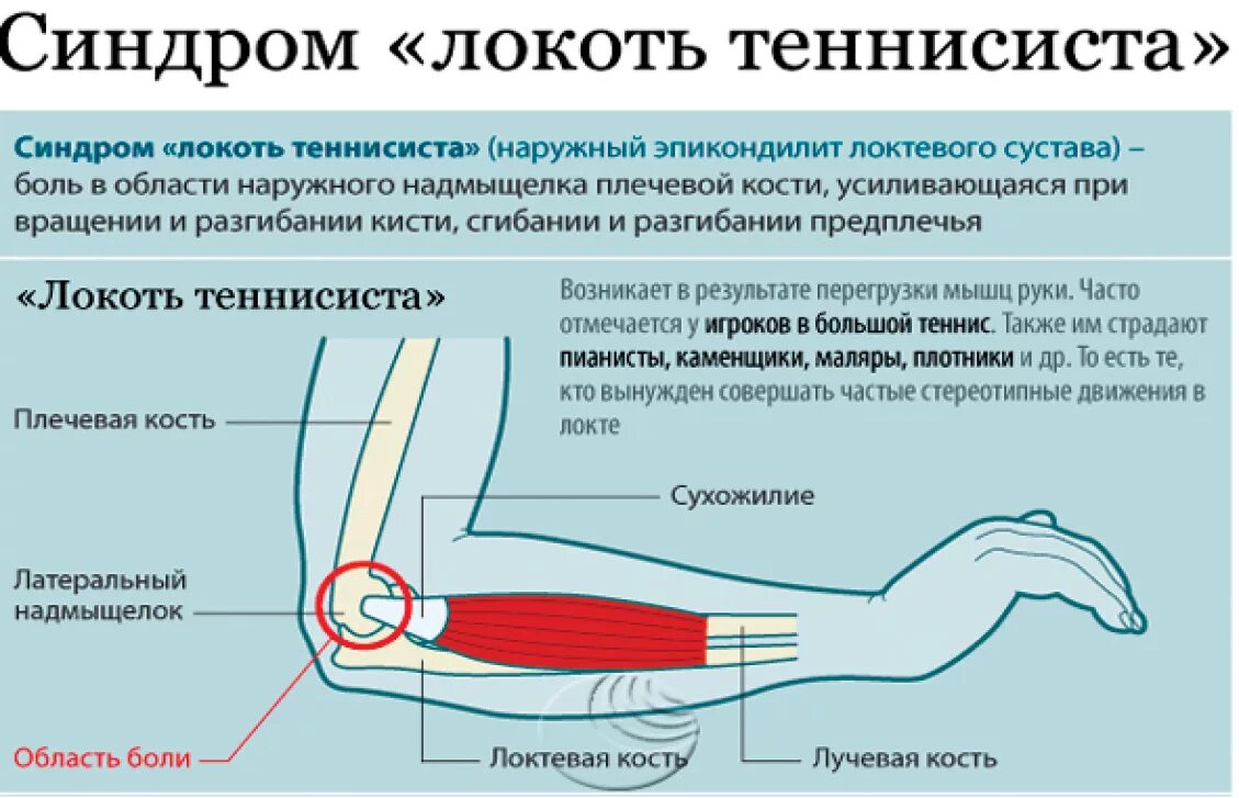 Больно разгибать. Наружный эпикондилит локтевого сустава симптомы. Локоть теннисиста эпикондилит. Латеральный надмыщелок локтевого сустава. Синдром локоть теннисиста.