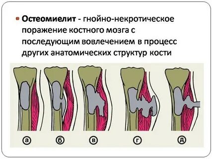 Воспаление перелома