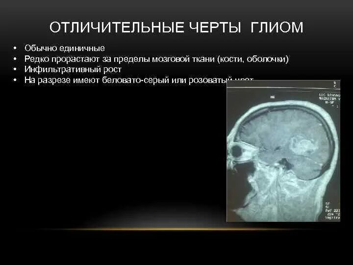 Диффузная глиома головного мозга. Глиома опухоль головного мозга симптомы. Глиома мозгового ствола.