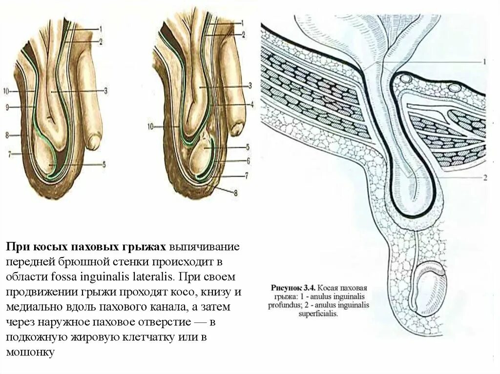 Паховая грыжа косая косая. Косая и прямая паховая грыжа. Грыжи косые и прямые пахового канала. Прямая и косая паховые грыжи