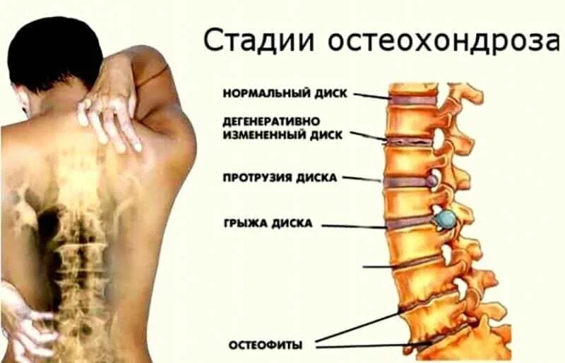 Боль в грудном отделе позвоночника