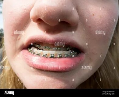 Close up of a teenage girl smiling in orthodontic brackets. 