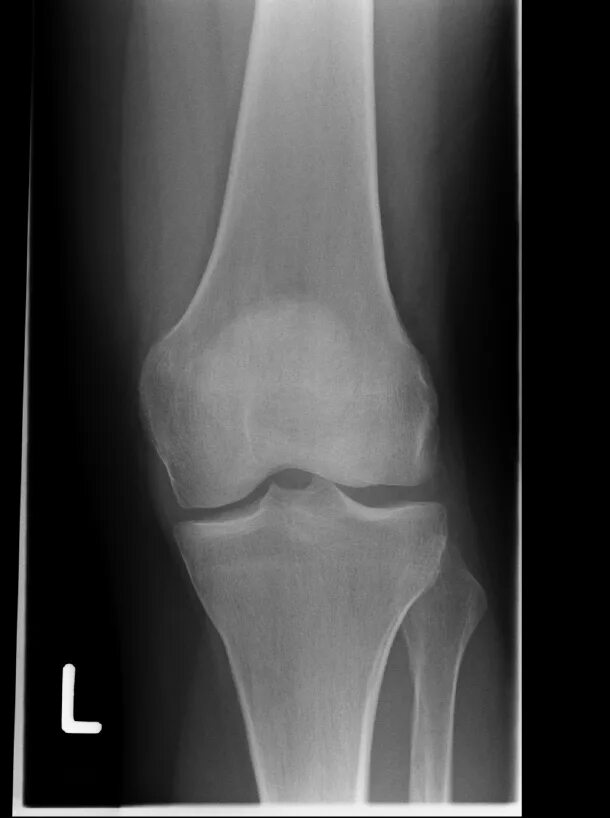 Рентгенограмма коленного сустава в норме. Деформирующий остеоартроз локтевого сустава рентген. Рентген левого коленного сустава норма. Коленный сустав рентген норма.