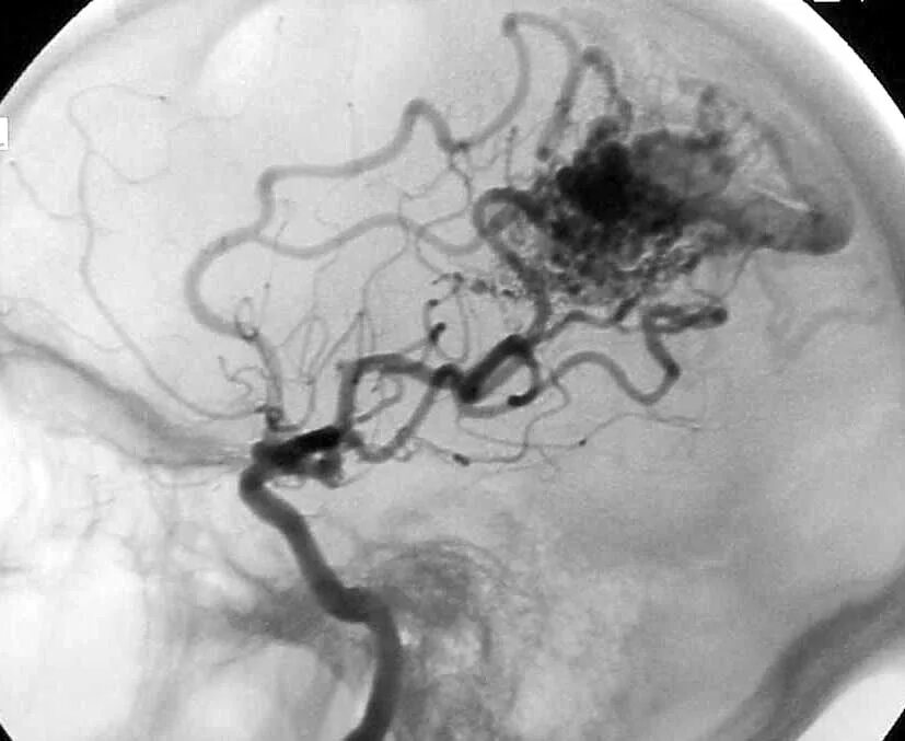 Сосудистая аномалия. Артериовенозная мальформация артерии. Арерио венозная мальформация. Мальформация сосудов головного мозга ангиография. Артериовенозная мальформация сосудов головного мозга.
