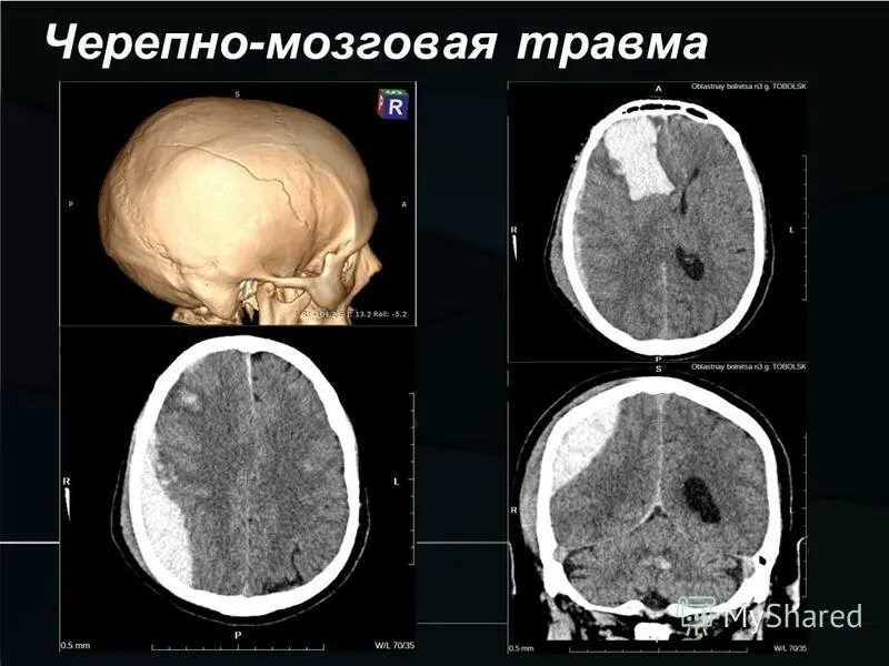 Чмт ушиб. Чмт ушиб
