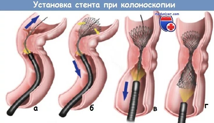 Стенд пищевода. Стентироыкник кишечника. Стентирование опухоли Толстого кишечника. Колоноскопия кишечная непроходимость. Стентирование опухоли прямой кишки.