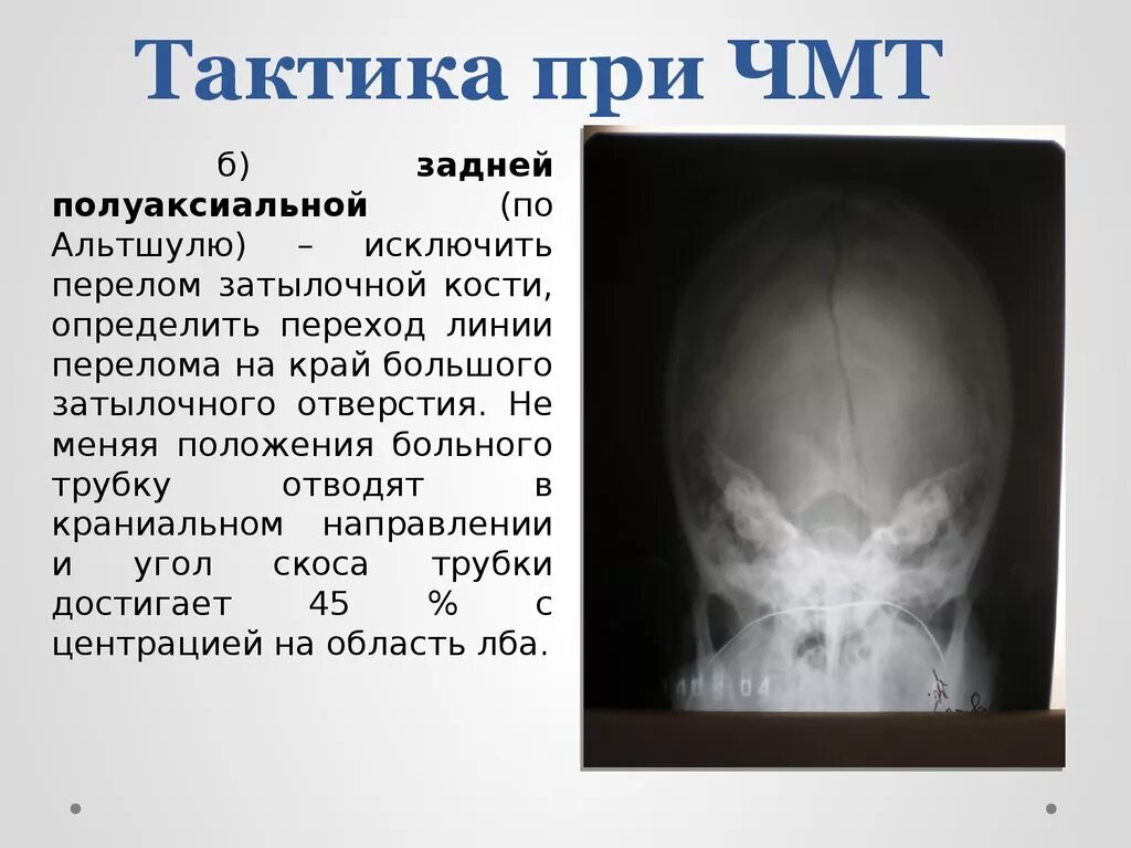 Для перелома основания черепа характерно. Перелом затылочной кости черепа рентген. Линейный перелом лобной кости рентген. Черепно мозговая травма перелом лобной кости. Перелом теменной кости черепа рентген.