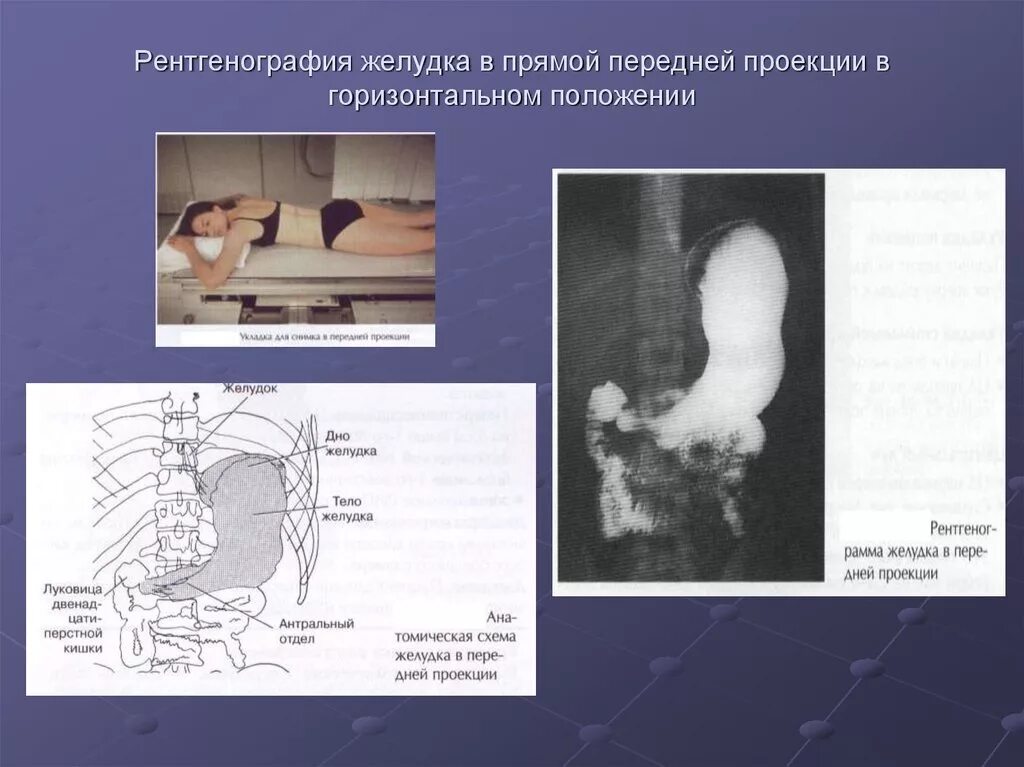 Контрастирование пищевода барием. Рентгенография пищевода желудка и ДПК. Рентген желудка в боковой проекции. Рентген с барием желудка и 12перстной. Скопия пищевода желудка