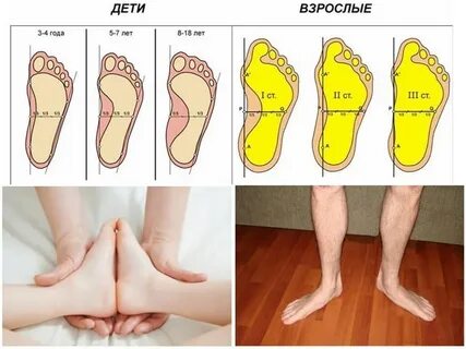 Как сделать плоскостопие 3 степени
