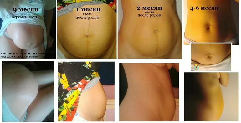 Какие должны быть выделения после кесарева сечения