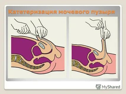 Проведение катетеризации мочевого пузыря женщина