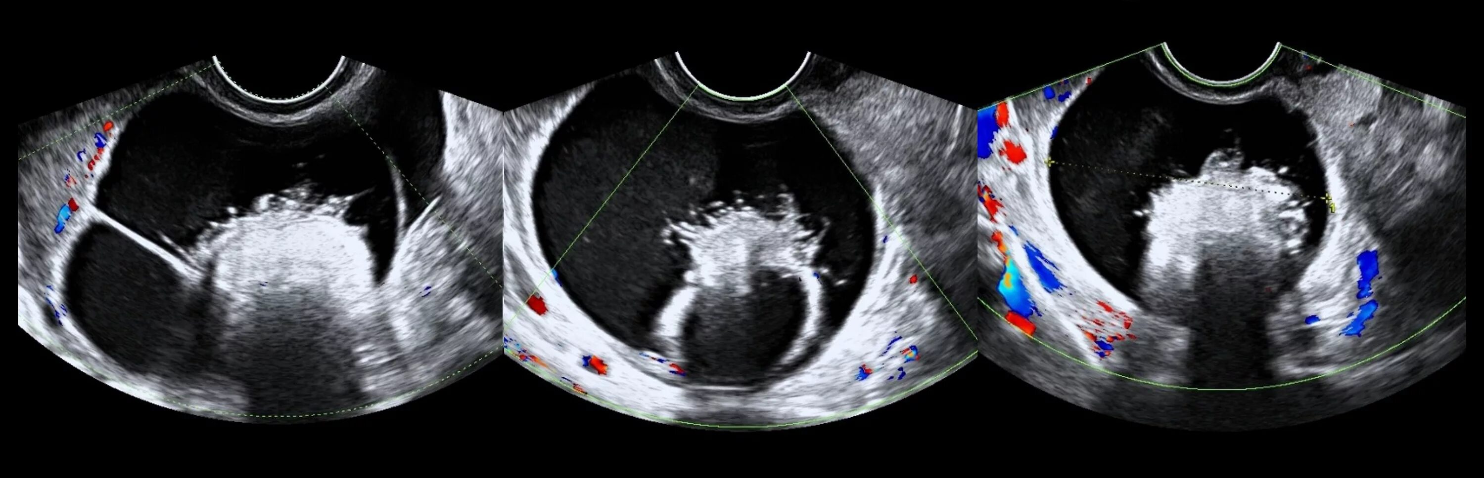 Киста яичника с перегородками. Эндометриоидная киста на УЗИ. Дермоидная киста яичника на УЗИ. Апоплексия кисты яичника на УЗИ. Дермоидная и фолликулярная киста.