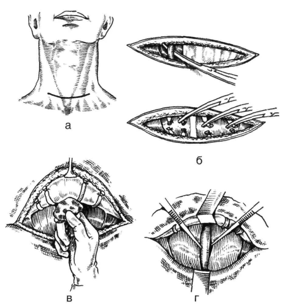 Сколько длится операция щитовидной. Субтотальной резекции щитовидной железы этапы. Субтотальная резекция щитовидной железы схема. Операция щитовидной железы.(по кохера и Николаева).. Субтотальная резекция щитовидной железы техника операции.