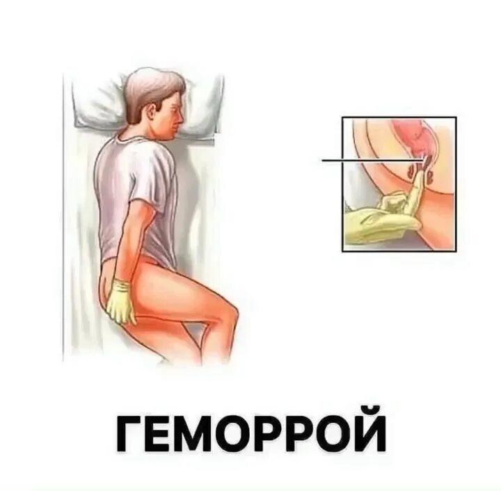 как правильно вставать свечку. введение свечи в прямую кишку. как правильно ввести свечку. как правильно вставить свечу ректально. как вставить свечу ректально.