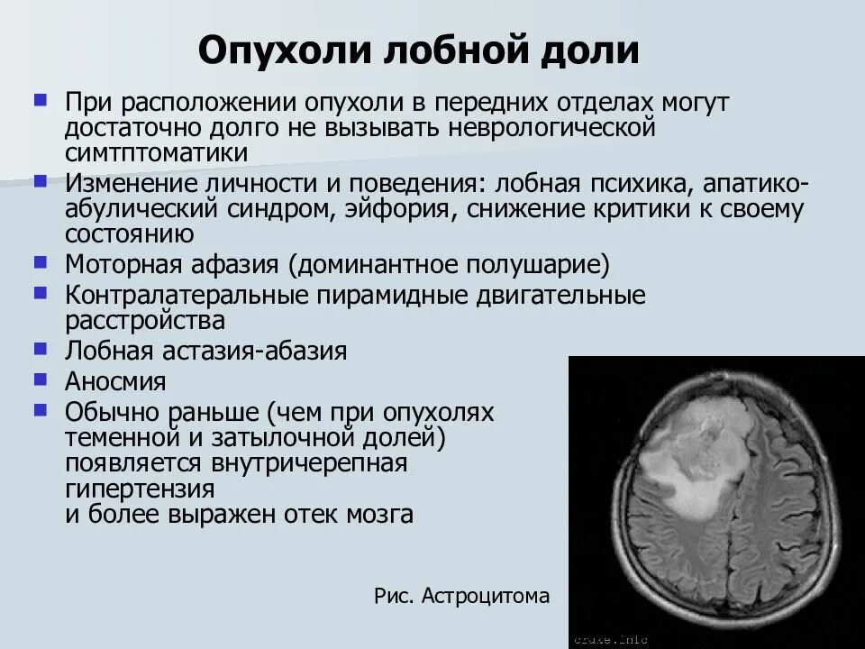 Образование в лобной доле. Диагностические критерии глиомы головного мозга. Особенности опухолей лобной доли. Клиника опухоли затылочной доли головного мозга. Симптомы, характерные для опухолей лобной доли.