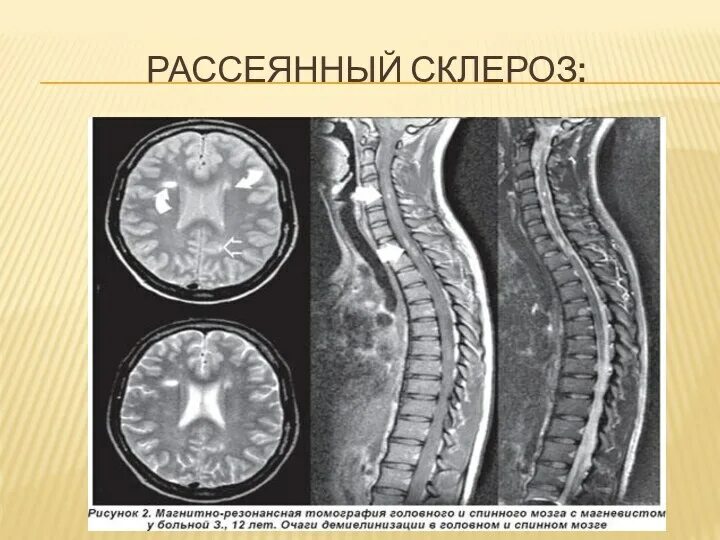 Демиелинизация головного. Демиелинизация спинного мозга мрт. Демиелинизирующие заболевания спинного мозга мрт. Мрт рассеянный склероз спинной мозг. Рассеянный склероз снимки мрт.