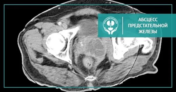 Гифки простаты. Кисты предстательной железы мрт. Абсцесс пербстательнойжелезы. Абсцесс предстательной железы. Абсцесс предстательной железы УЗИ.