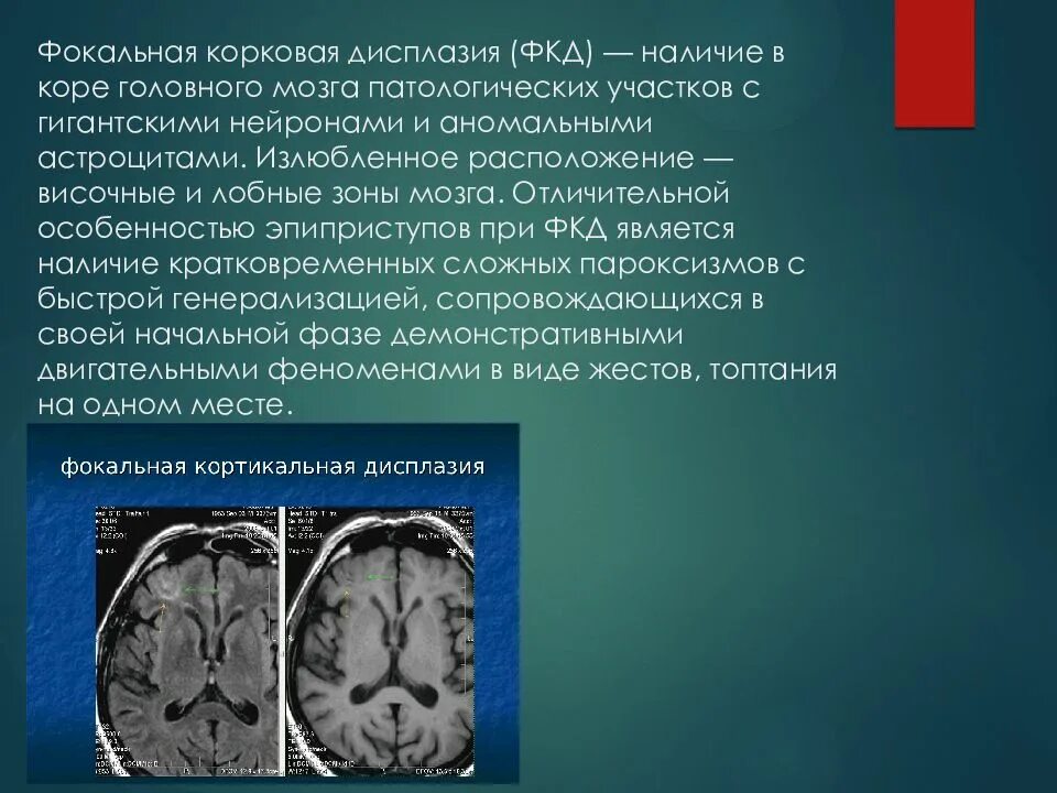 Фокальная корковая дисплазия лобной доли. Фокальная кортикальная дисплазия мрт. Фкд головного мозга мрт. Фокальная кортикальная дисплазия мрт. Фкд мрт.