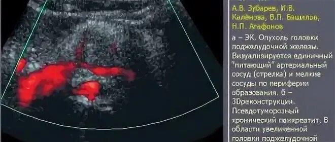 УЗИ поджелудочной железы Изранов. УЗИ поджелудочной железы медунивер. Сколько часов нельзя есть перед УЗИ поджелудочной. Плохо визуал и поджелудочная на УЗИ.