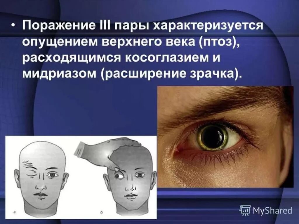 Поражение черепных. Поражение 3 пары чмн. парез iii пары черепно-мозговых нервов. паралич парез глазодвигательного нерва. поражение 3 пары черепных нервов.