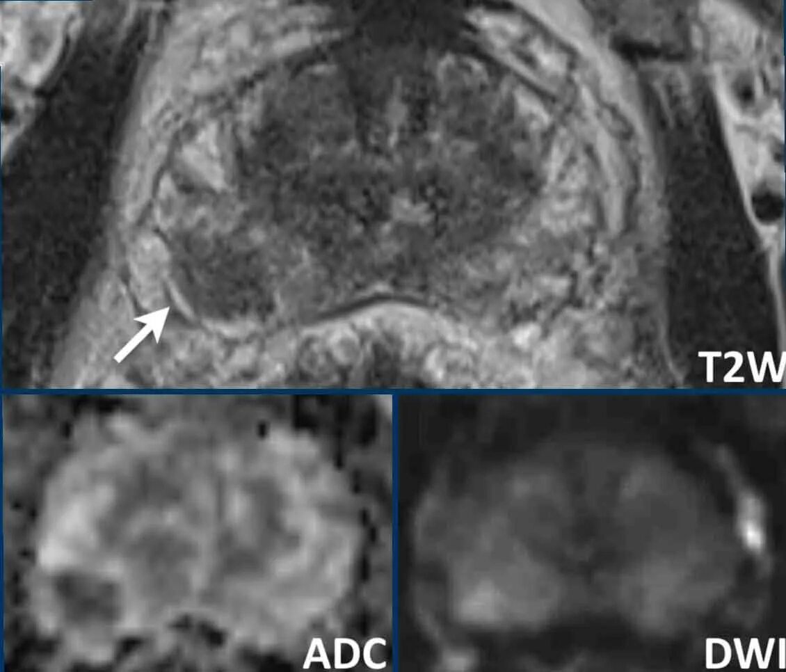Предстательная железа pirads. Пайрадс мрт. Dwi ADC мрт. Предстательная железа Pi rads мрт. Pirads мрт предстательной железы.