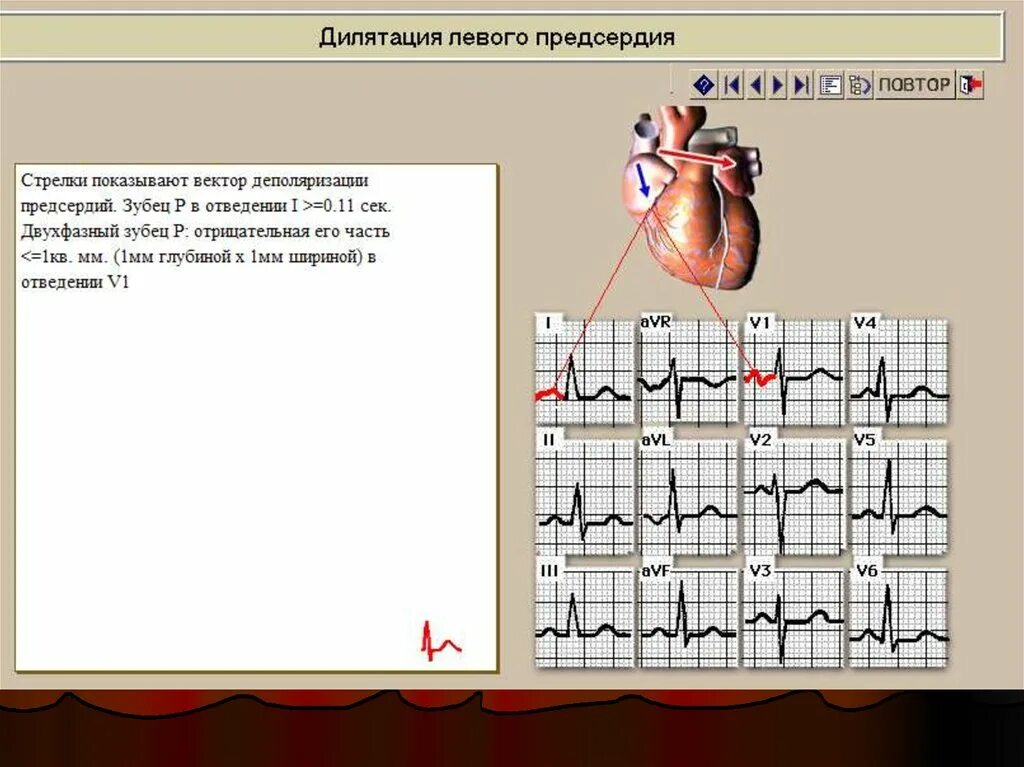 Дилатация правых отделов. Дилатация желудочков ЭКГ. Дилатация предсердий на ЭКГ. Гипертрофия предсердий на ЭКГ. Дилатация правого предсердия ЭКГ.