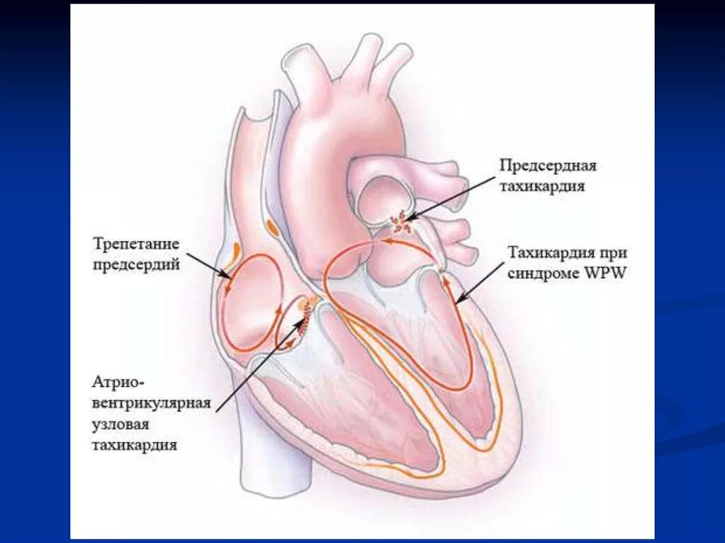 Аритмический шок. Наджелудочковый гребень сердца. Тахикардия. Предсердия. Тахикардия предсердий.