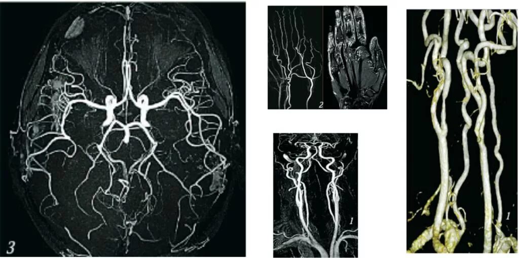 Сосуды головного мозга норма. Кт ангиография головного мозга. Брахиоцефальные артерии кт. Мрт сосудов головного мозга (мрт-ангиография). Каротидная ангиография головного мозга.