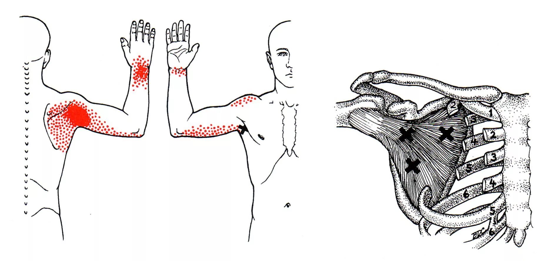Иррадиация боли в левую лопатку. Миофасциальный синдром малой грудной мышцы. Подлопаточная мышца триггерные точки. Миофасциальный синдром большой грудной мышцы. Триггерные точки малой грудной мышцы.