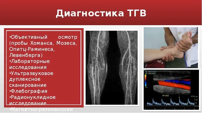 Клиника тромбоз глубоких вен нижних конечных. Симультанный тромбоз глубоких вен. Тромбоз глубоких вен бедра клиника. Тромбоз глубоких вен (ТГВ) – что это такое?. Диагностика тромбов