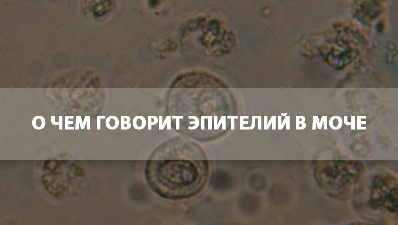 Почему в моче хлопья. Наличие плоского эпителия в моче. Переходные эпителии в моче. Эпителий плоский в моче норма. Эпителий в моче это о чем говорит.