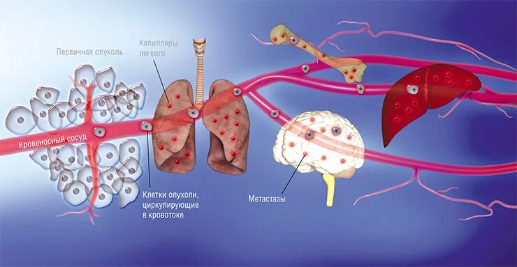 Распад органов. Схема метастазирования опухоли. Раковые клетки метастазы. Метастазирование раковых опухолей. Метастазирование рисунок.